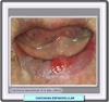 Carcinoma espinocelular del labio inferior