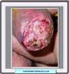 Carcinoma espinocelular en el pene