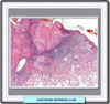 Histología de un carcinoma espinocelualr de grado I