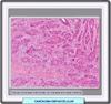 Histología de un carcinoma espinocelular de grado IV