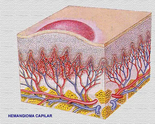 Hemangioma capilar