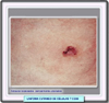 Linfoma de células T grandes CD30+
