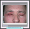 Imagen de un pacientes con acne agminata