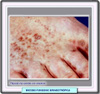 Variante siringotrópica de la micosis fungoides