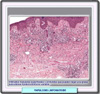 Histología de la papulosis linfomatoide
