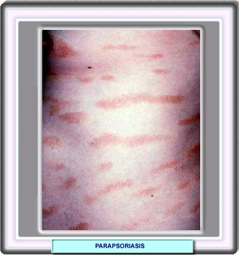 icd 10 cm code for history of psoriasis