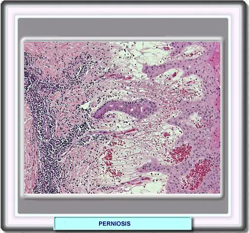 Histologia de la perniosos