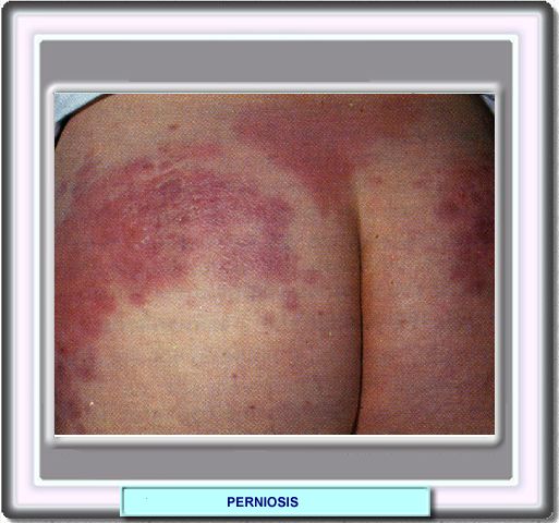 Perniosis en mujeres obesas