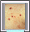 Pitiriasis liquenoide
