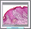 Histología de la pitiriasis rosada