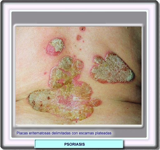 Tpicas placas de la psoriasis