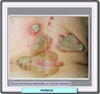 Típica psoriasis en placas