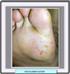 Pustulosis plantar