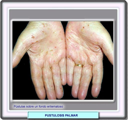 Aspecto de las manos con pustulosis palmar