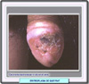 Lesiones en la eritroplasia de Queyrat