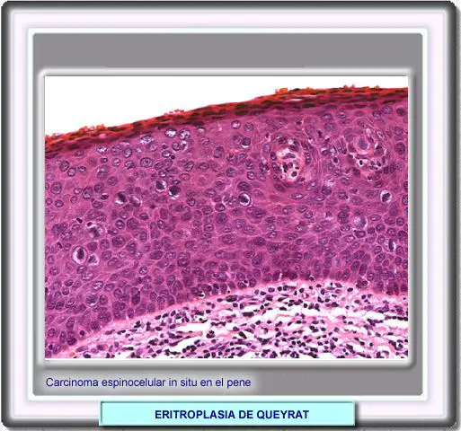 Eritroplasia de Queyrat