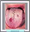 Lesiones orales en el síndrome de Reiter
