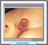 Escabiosis en pediatría