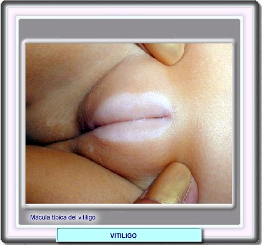 Mcula focal afectando el rea vaginal