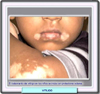 Tratamiento del vitiligo en los nios