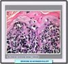 Histología de la reticulosis pagetoide