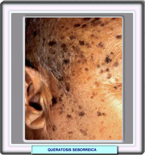 Lesiones mltiples en la cara