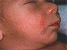 Coleccin de imgenes en DERMAWEB