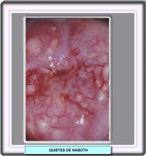 Quiste sebaceo en el cuello del utero