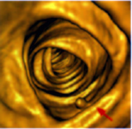 Pólipo rectal