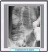 Radiografía del síndrome de Peutz-Jeghers