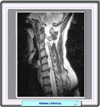 hernia discal