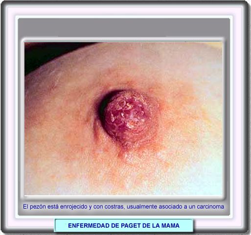 Fotografia clnica de un pezn afecto de la enfermedad de Paget