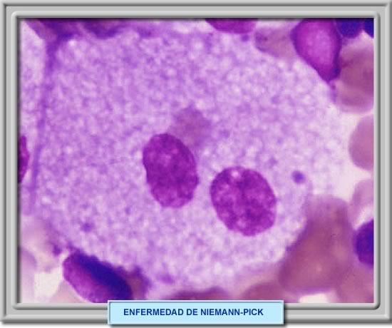 Clulas de Niemann-Pick en aspirados de mdula sea