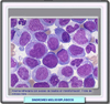 Anemia refractactaria con exceso de blastos en transformación