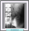 Esplenomegaliia en un caso de mielofibrosis