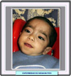 Imagen clínica de un niño con enfermedad de Niemann-Pick