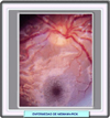 Mancha roja en la macula de la retina