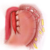 Esquema de la cirugía que se practica en la acalasia