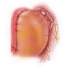 Esquema de la cirugía que se practica en la acalasia