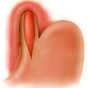 Esquema de la cirugía que se practica en la acalasia