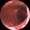 Imagen endoscpica de una hernia 