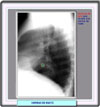 Imagen radiológica de una hernia paraesofágica