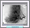 Arteriograma mostrando los quistes 