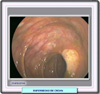 Colonoscopia en la colitis ulcerosa