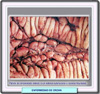 Fotografía de la mucosa en la enfermedad de Crohn