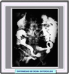 Enfermedad de Crohn: Enteroclisis