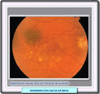 Fondo de ojo de una degeneración macular seca