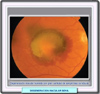 Fondo de ojo de una degeneración macular 