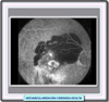 Fotograma de angiografía fluoresceína de una neovascularización coroidea oculta