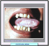 Leucoplasia homogénea